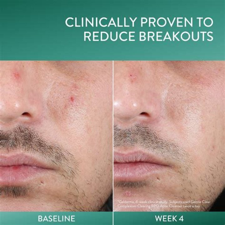 How do you bring a pimple to a head in minutes?