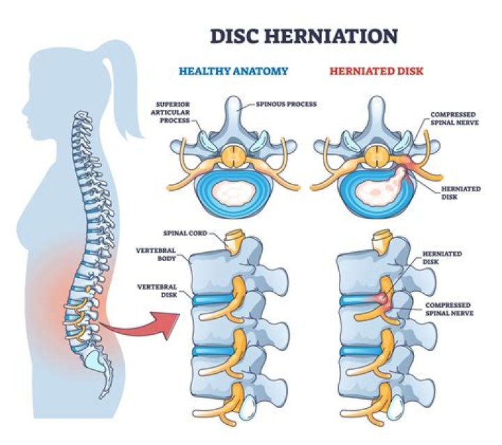 How do you calm a herniated disc?