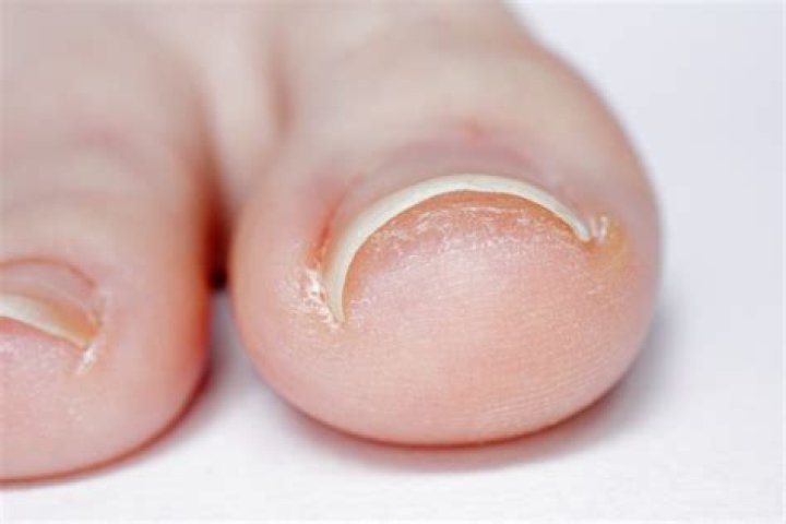 How do you cut thick curved toenails?