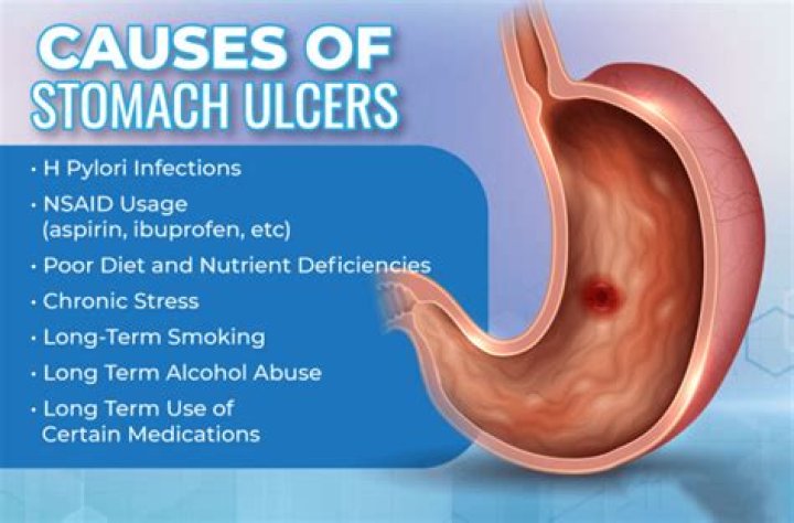 How do you detect a stomach ulcer?