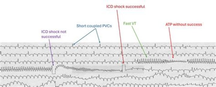 How do you feel after ICD shock?