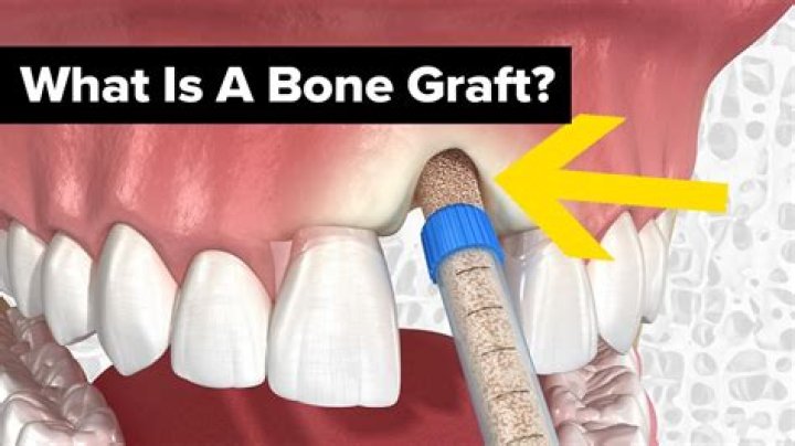 How do you fix a failed bone graft?