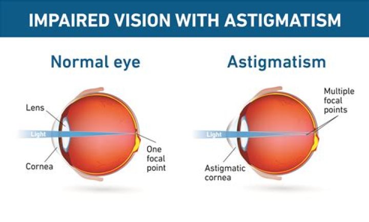 How do you fix astigmatism?