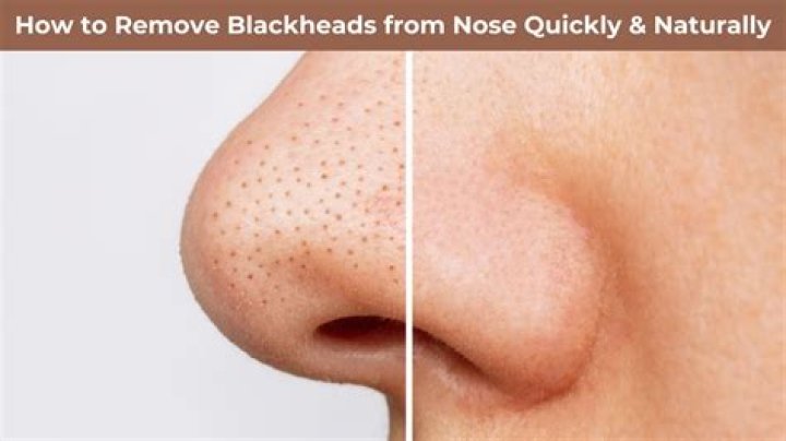 How do you get rid of blackheads without popping them?