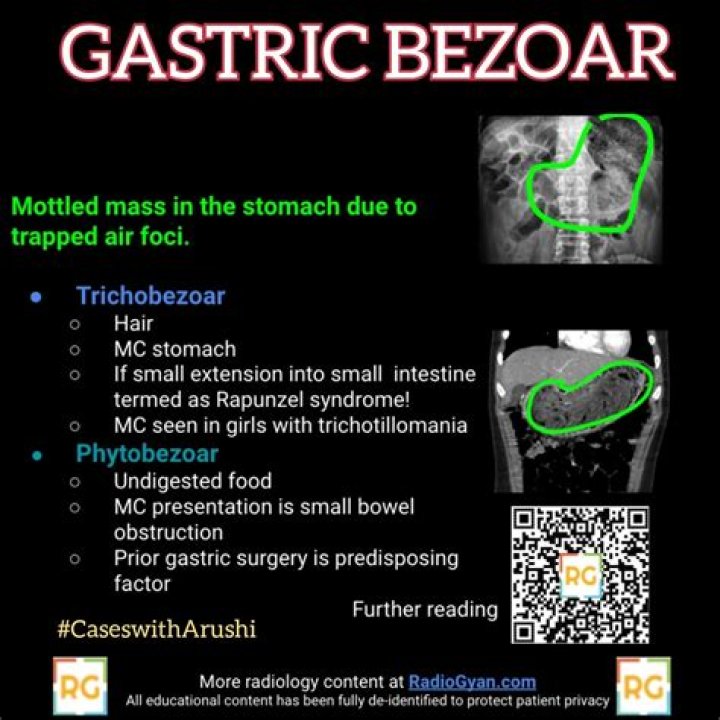 How do you get rid of gastric bezoar?