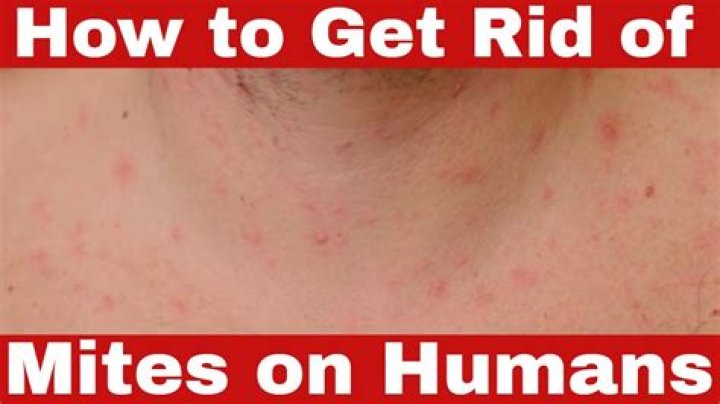 How do you get skin mites?