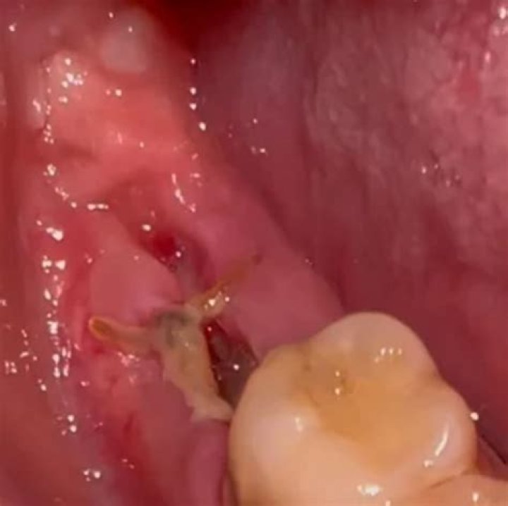 How do you know if blood clot is dislodged from wisdom teeth?