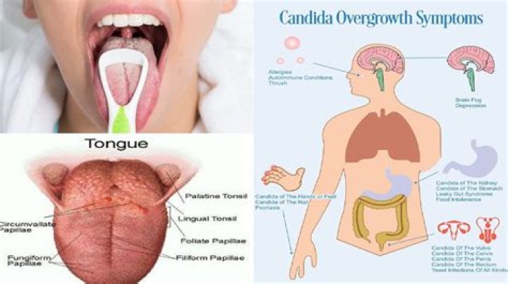 How do you know if you have Candida overgrowth?