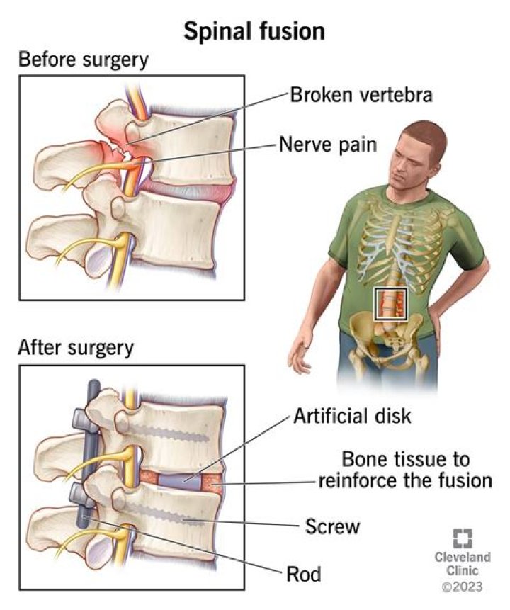 How do you know if you need spinal fusion?