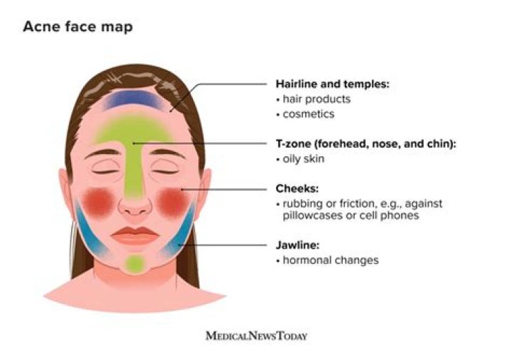 How do you make a zit come to a head?