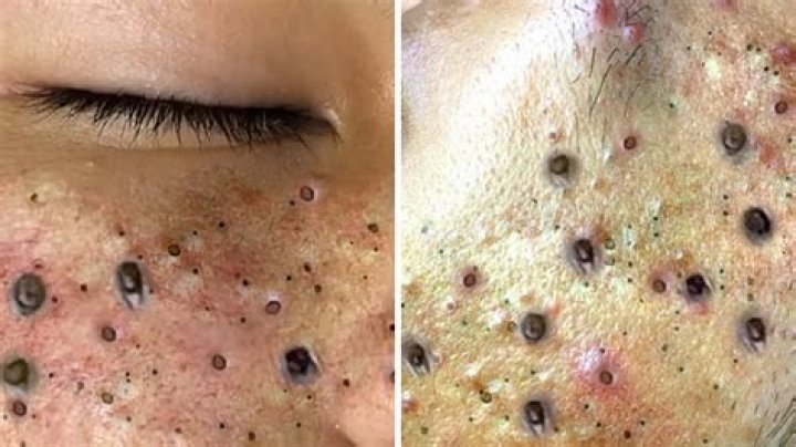 How do you pop a blackhead?