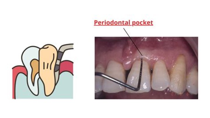 How do you shrink periodontal pockets?