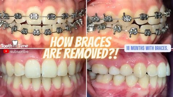 How do you smile after getting braces off?