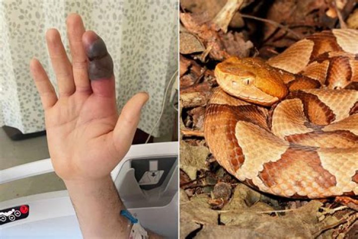 How do you treat a copperhead bite?