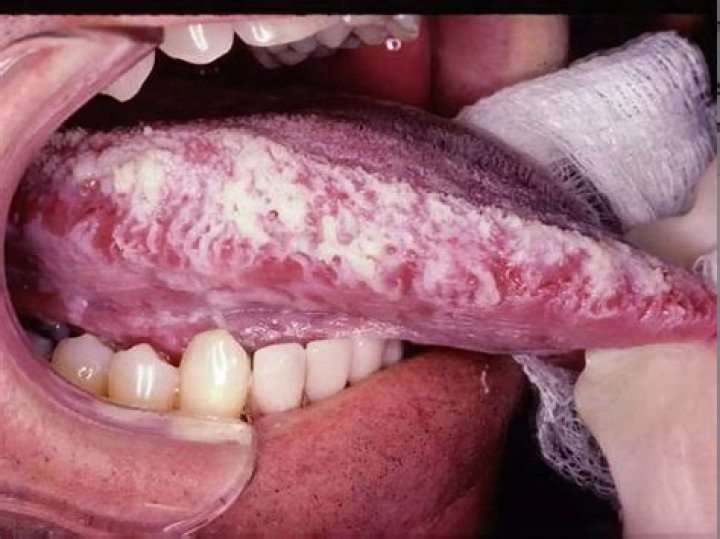 How do you treat hairy leukoplakia?