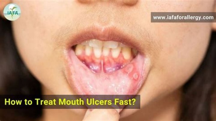How do you treat mouth sores?