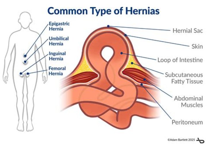 How does a hernia feel?