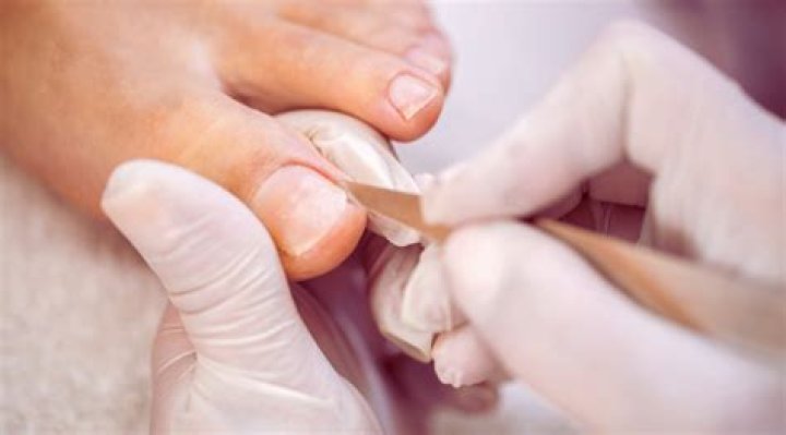 How does a podiatrist remove cracked heels?
