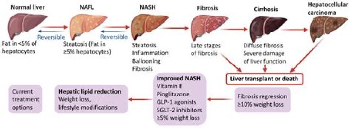How fast does fatty liver progress?