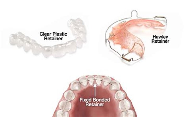 How hot does it have to be for retainers to melt?
