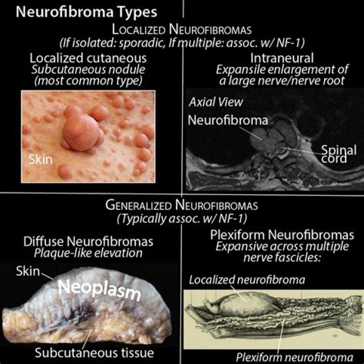 How is neurofibroma diagnosed?