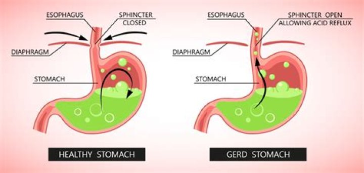How is pill induced esophagitis treated?