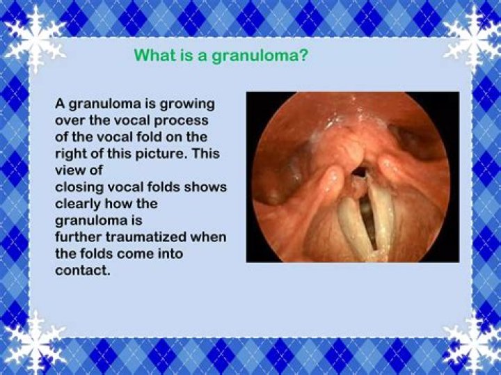 How large can a granuloma get?