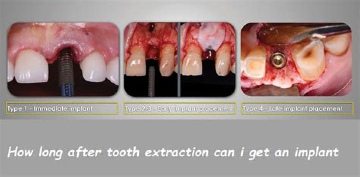 How long after extraction can I get implant?