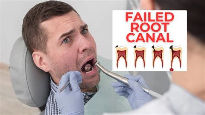 How long can a failed root canal last?