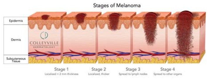 How long can melanoma go untreated?