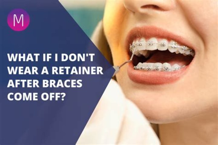 How long can you go without a retainer after getting braces off?