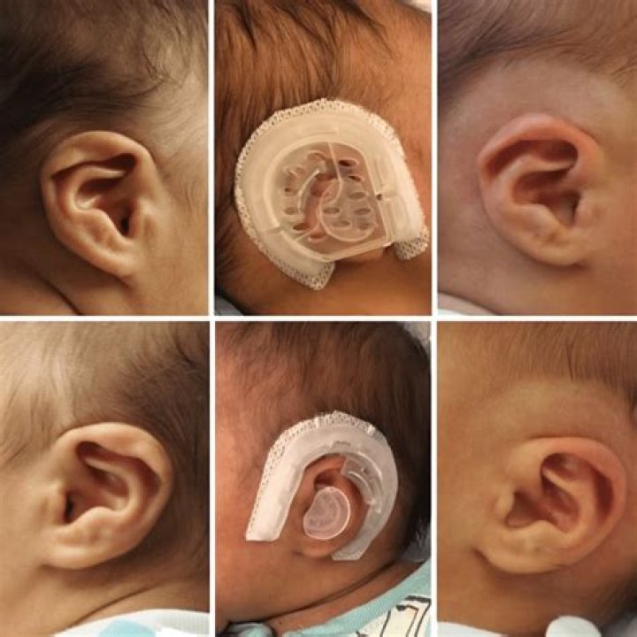 How long do ear molds last?