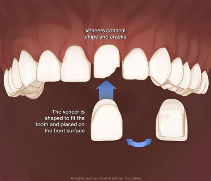 How long do veneers take to put on?