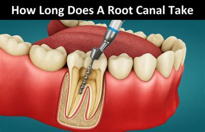 How long does a redo root canal take?