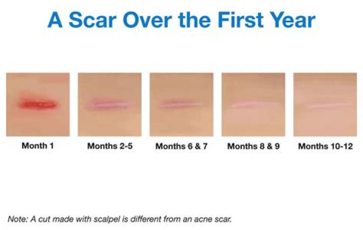 How long does a scar stay pink?