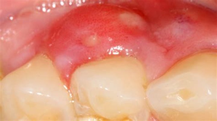 How long does gum abscess last?