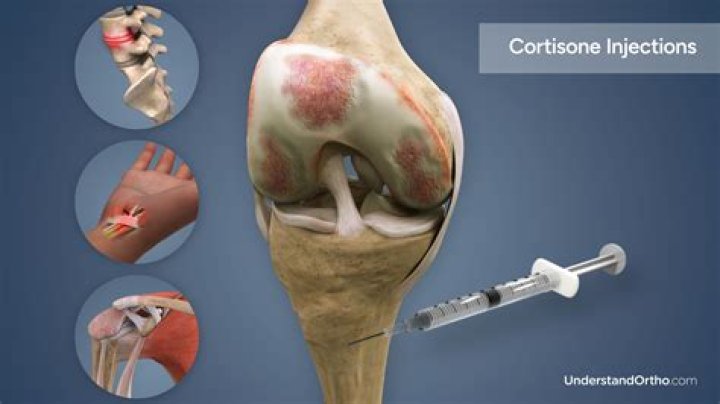 How long does it take for a cortisone shot to work in the knee?