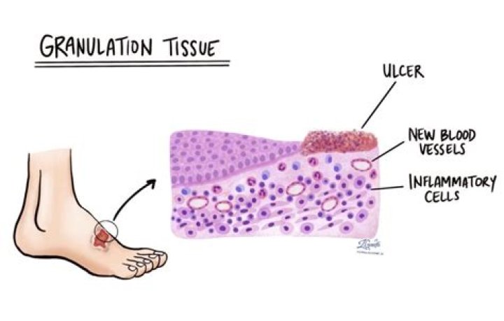 How long does it take for granulation tissue to heal?