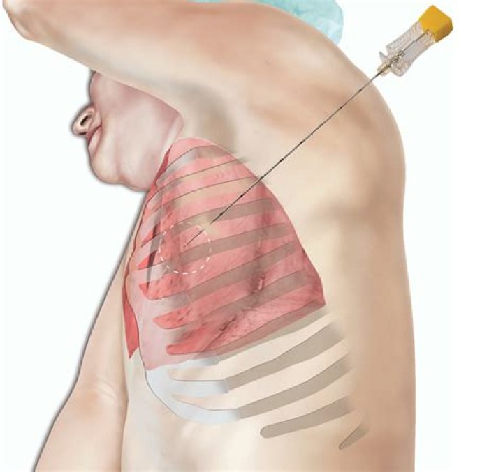How long does it take to get a lung biopsy back?