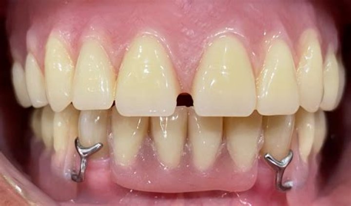 How long does it take to have a denture made?