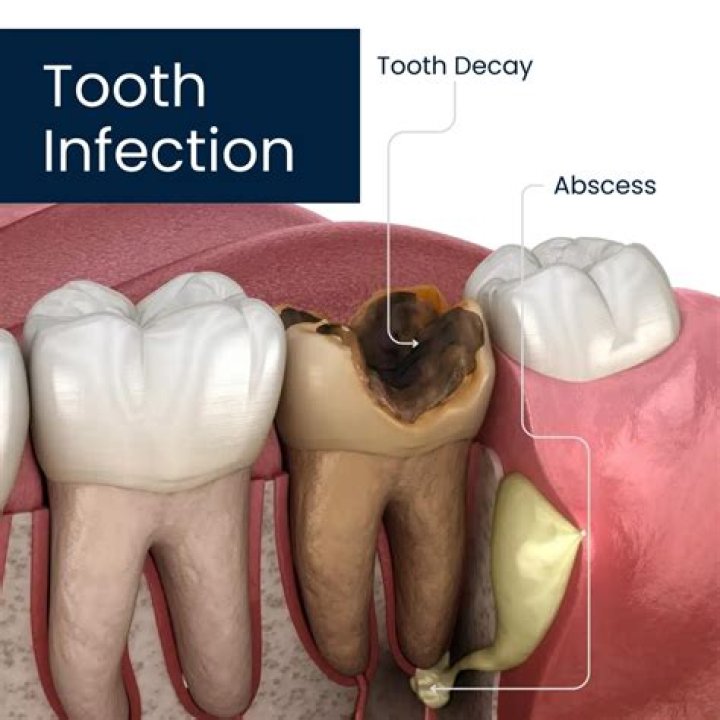 How long does it take to recover from a tooth infection?