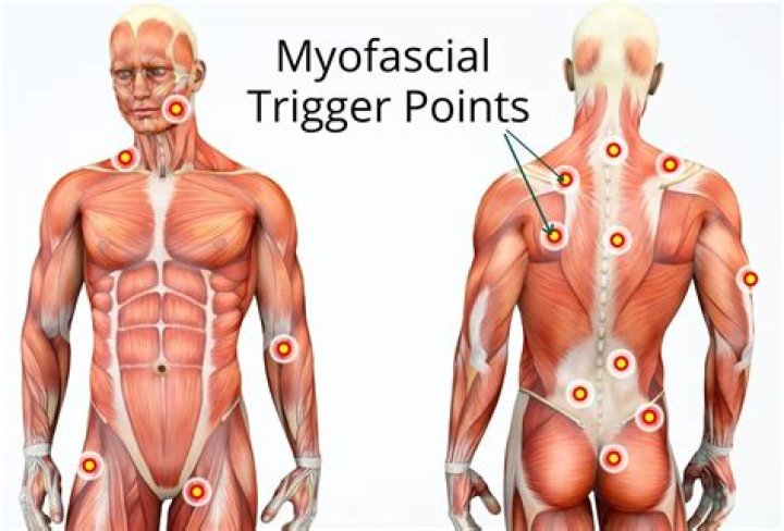 How long does myofascial trigger points last?
