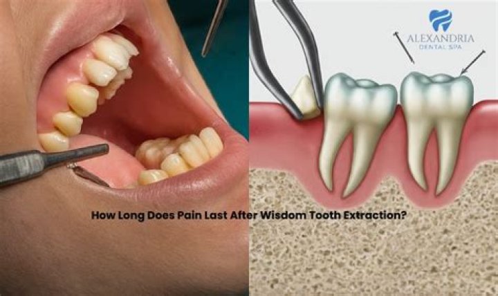 How long does pain last after getting dentures?