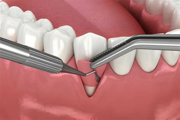 How long does periodontal surgery take?
