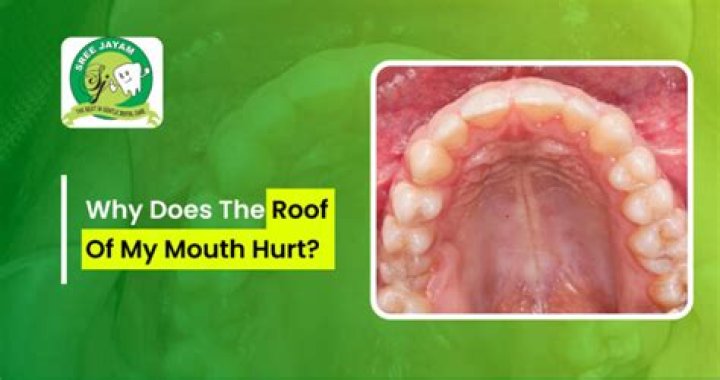 How long does roof of mouth hurt after gum graft?