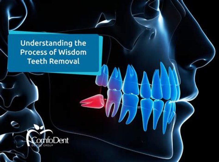 How long is wisdom tooth surgery?