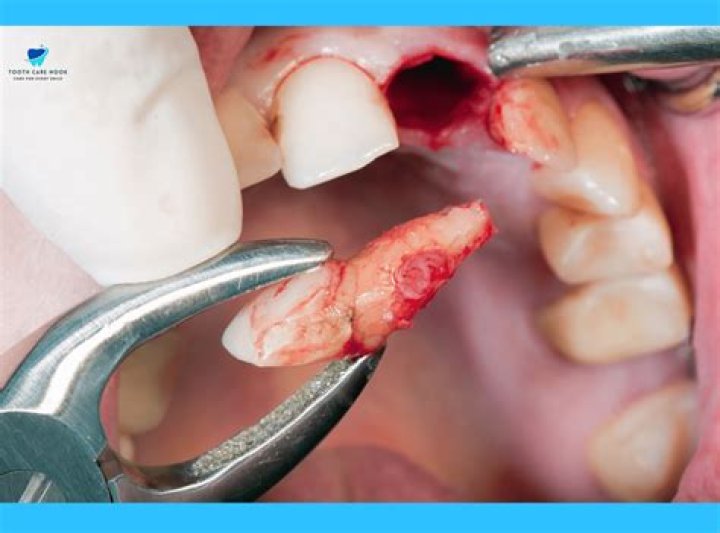 How long will blood clot stay after tooth extraction?
