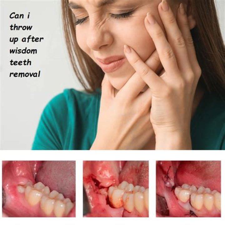 How long will my jaw hurt after wisdom teeth removal?