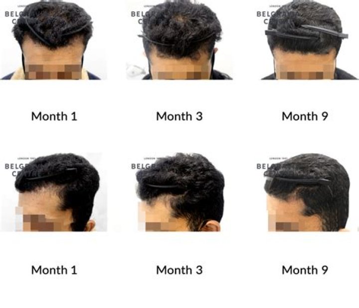 How many months will hair grow?