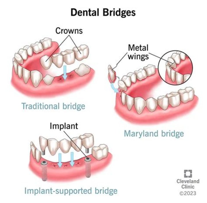 How many teeth can a permanent bridge have?
